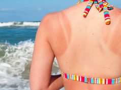 Kako pravilno tretirati kožu opečenu od sunca