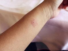 Ovo trebate učiniti ako vas ujede stršljen